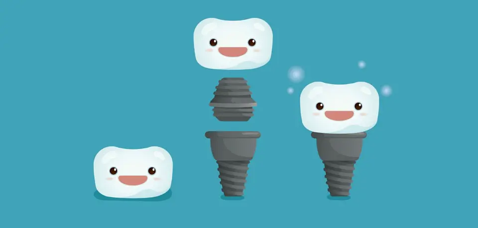 dental implants