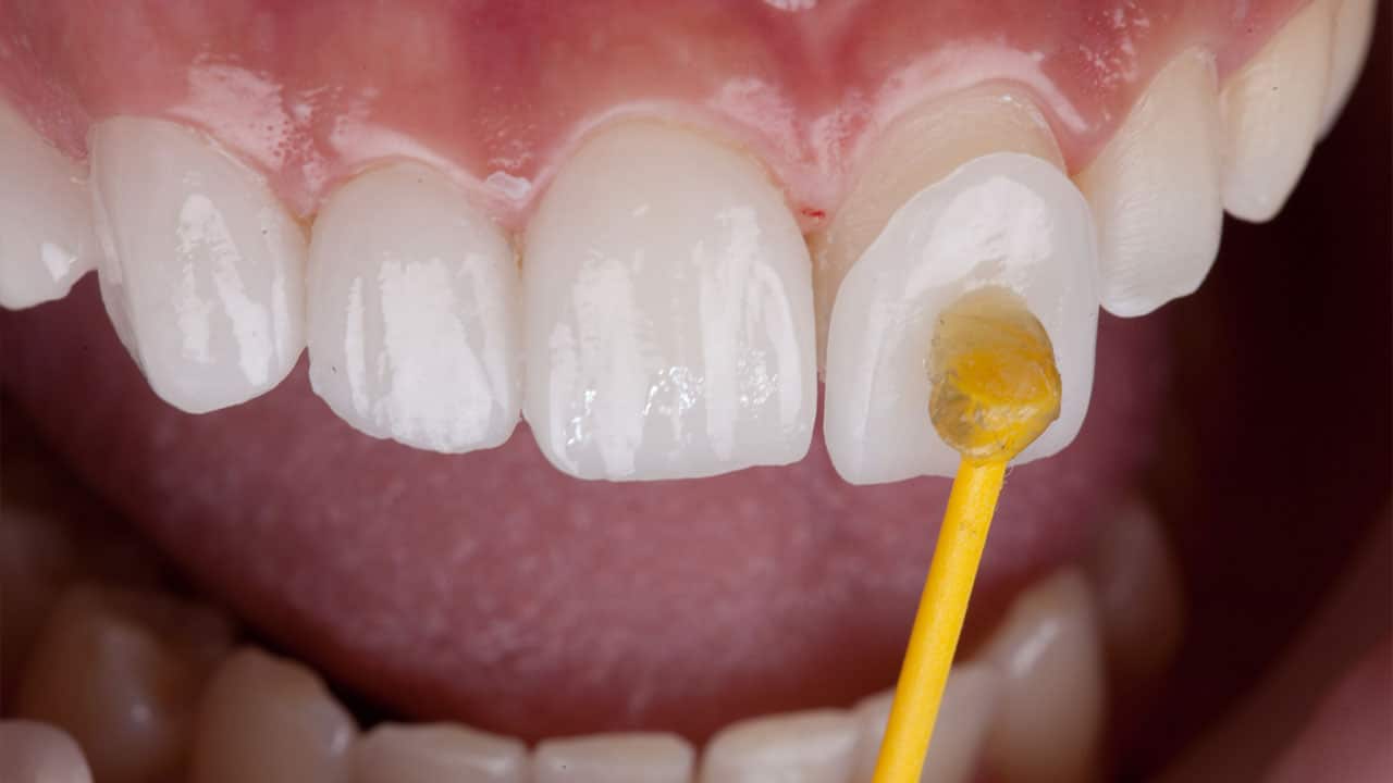 Dentist placing dental veneers