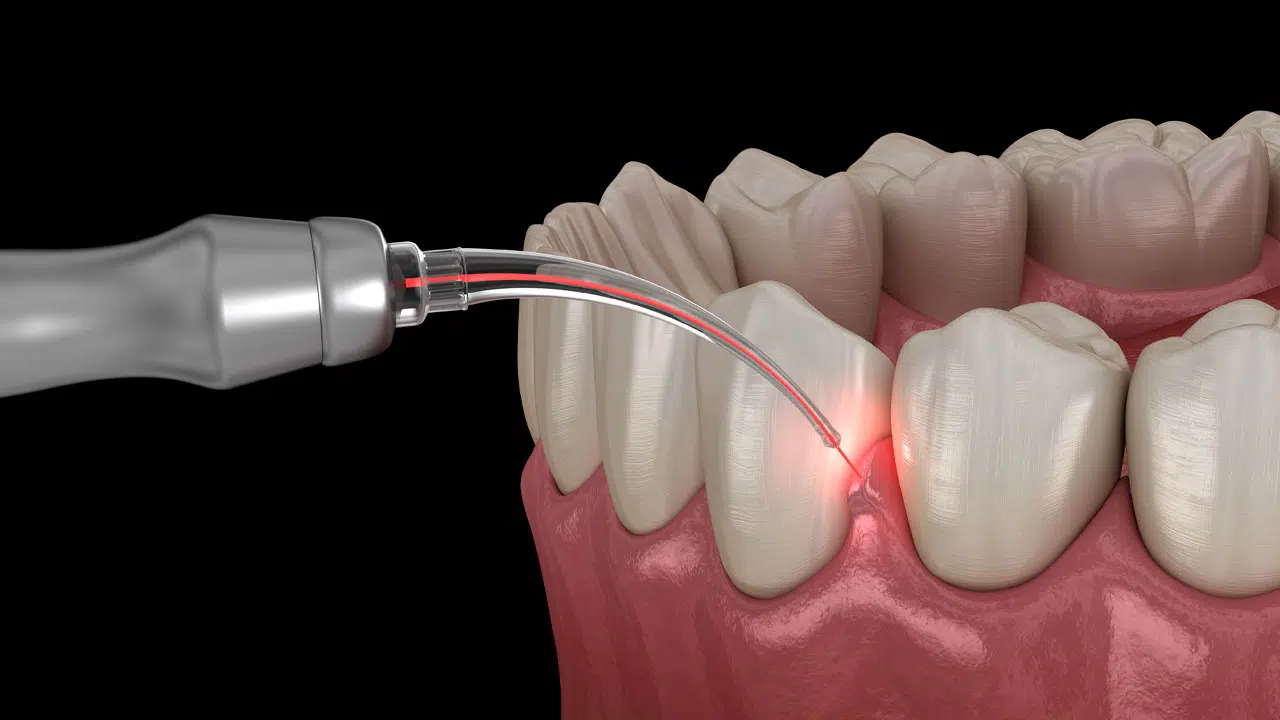 Graphic showing a dental laser