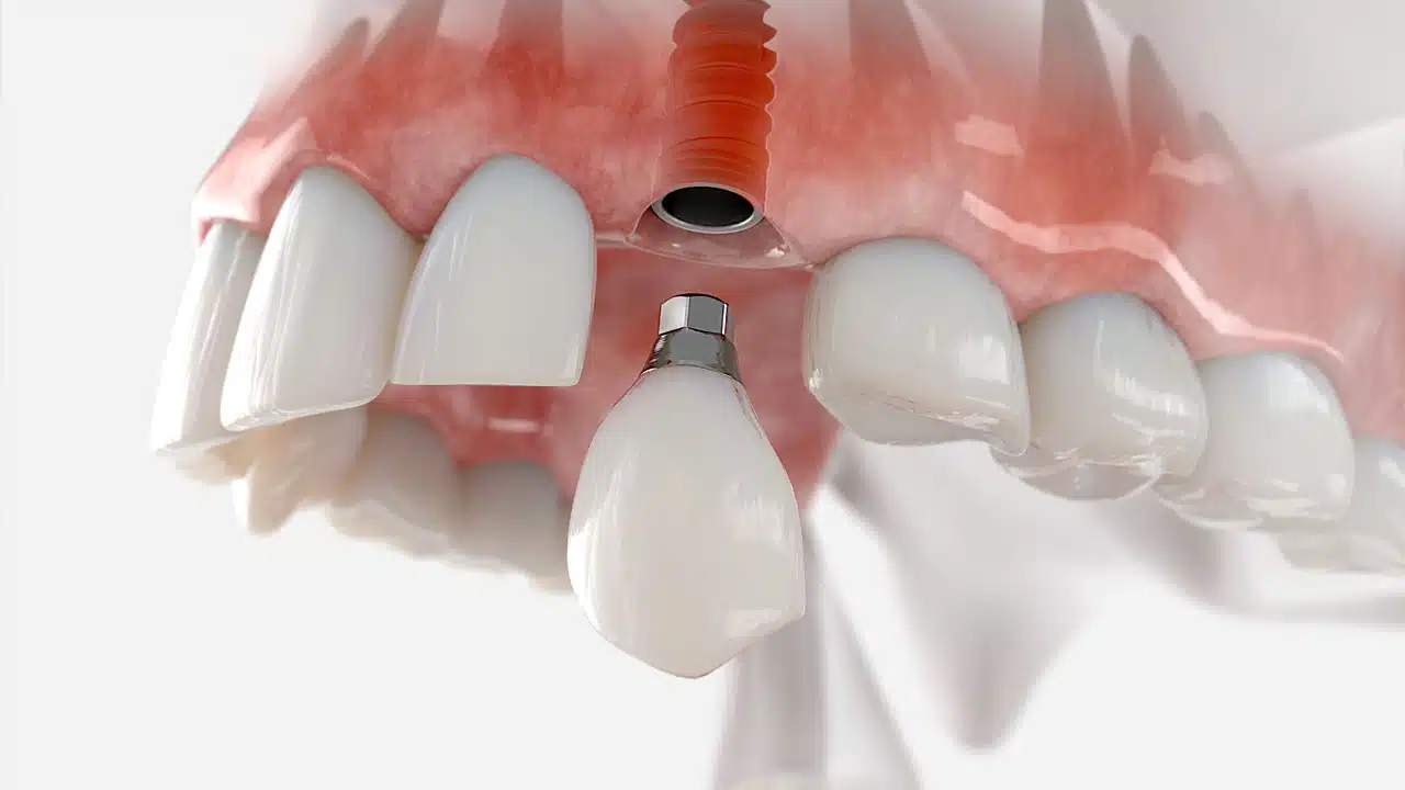 Graphic showing a dental implant