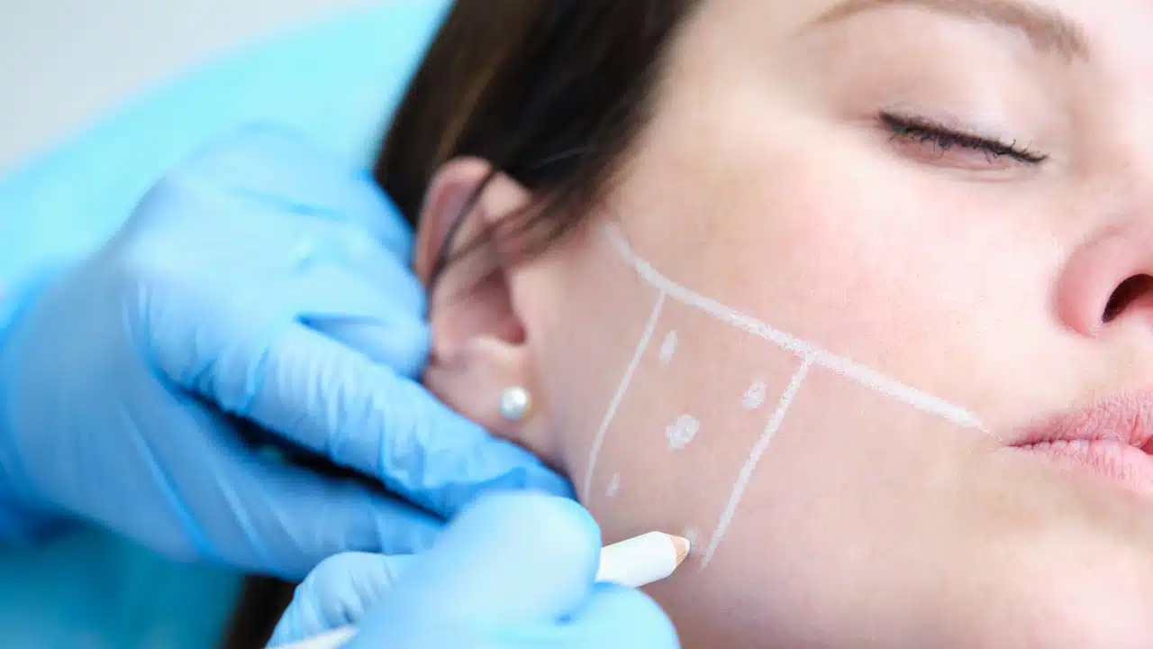 Dentist marking a girl's face to inject botox to correct bruxism