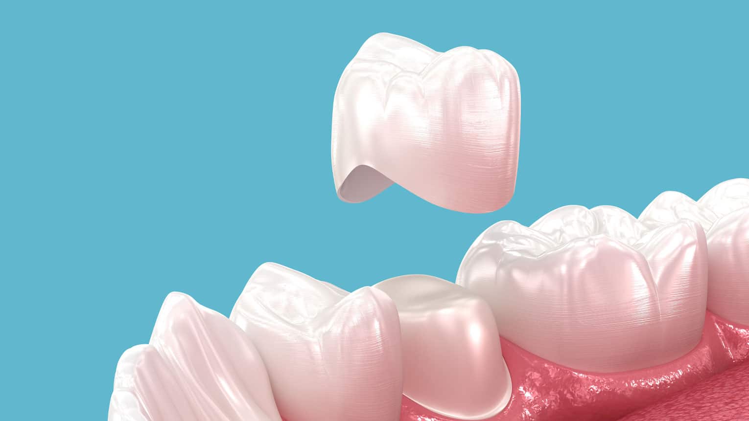 3 Benefits of Same-Day Crowns