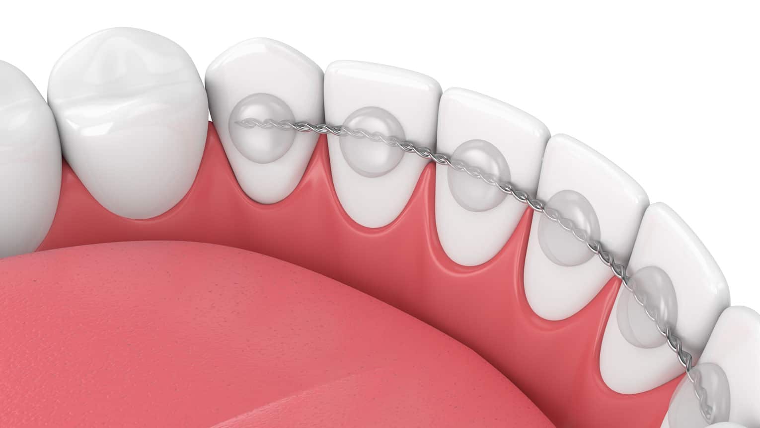 Are Permanent Retainers Worth It?