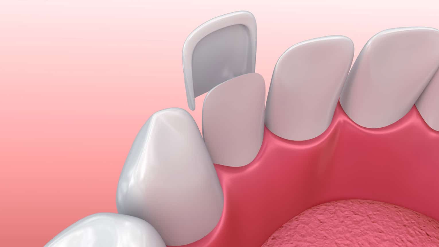 Are Veneers Permanent?