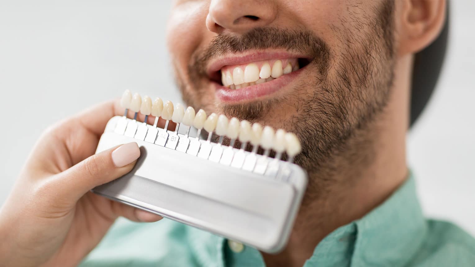 Dental Bonding vs. Veneers: Which Is Right for You?
