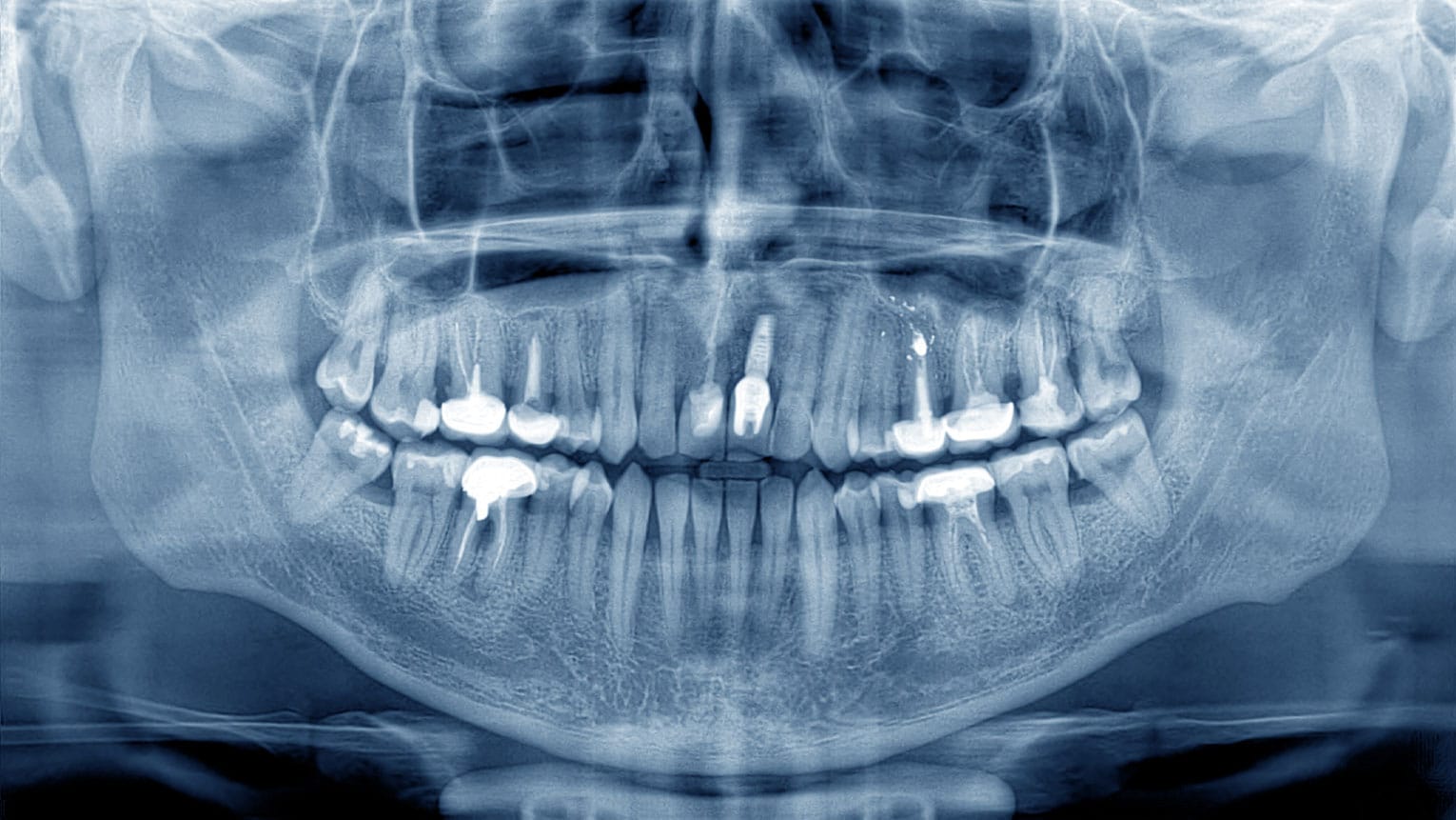 Do You Need a Bone Graft with a Dental Implant?