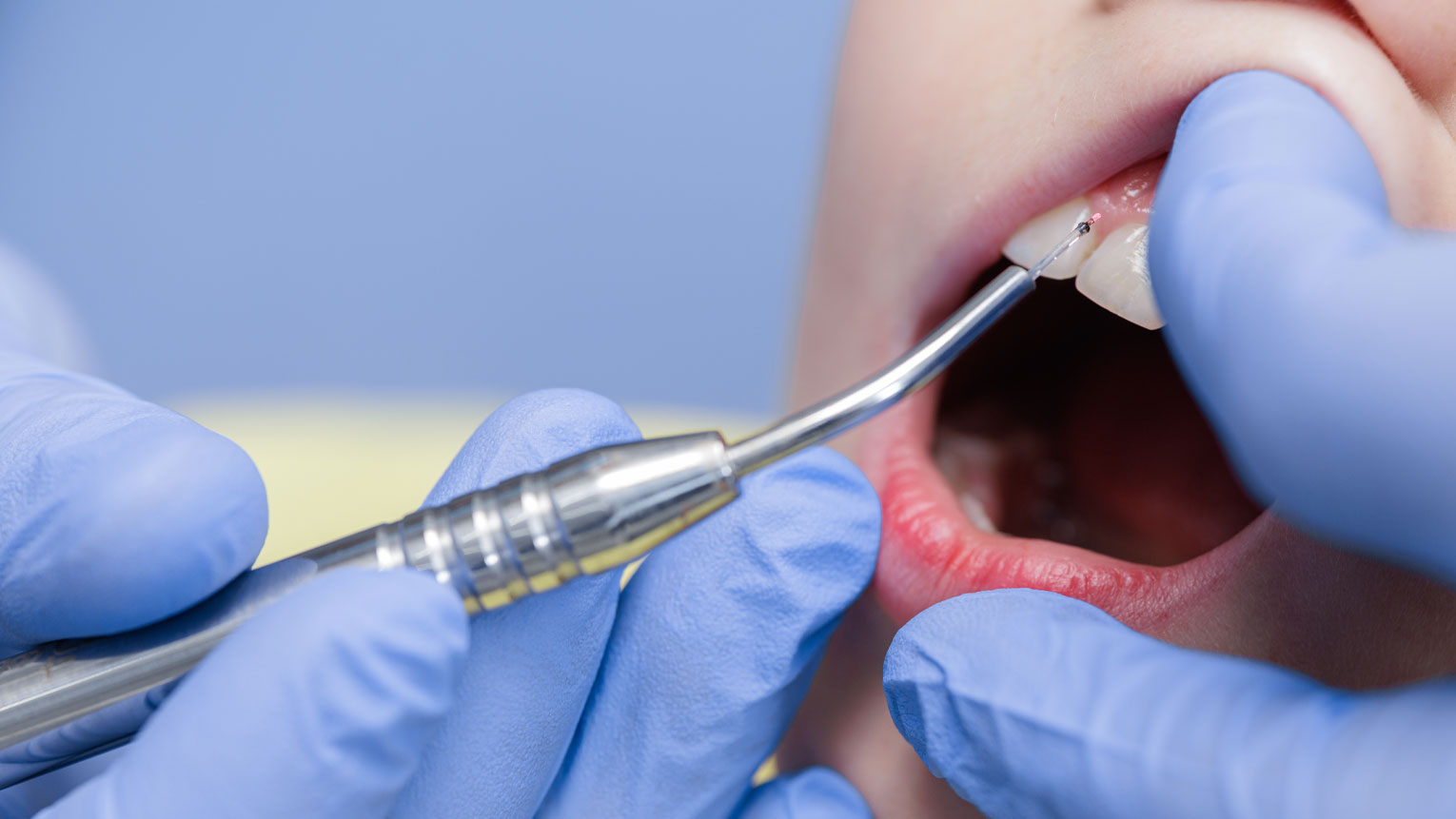 How Laser Dentistry Works: The Science Behind Pain-Free Procedures