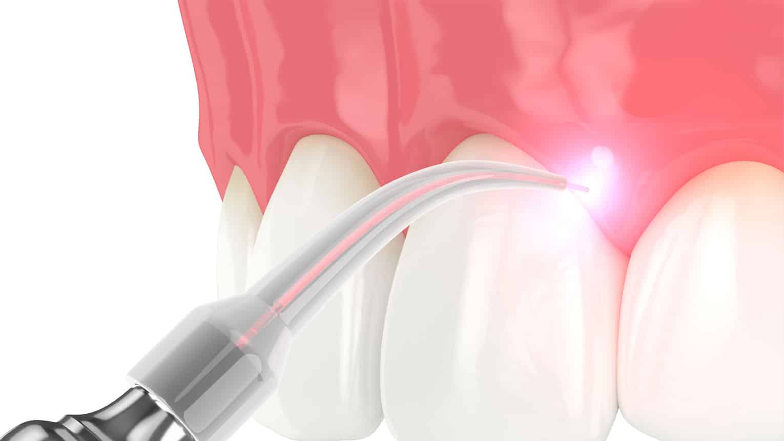 Laser Dentistry: What it is and How it Works