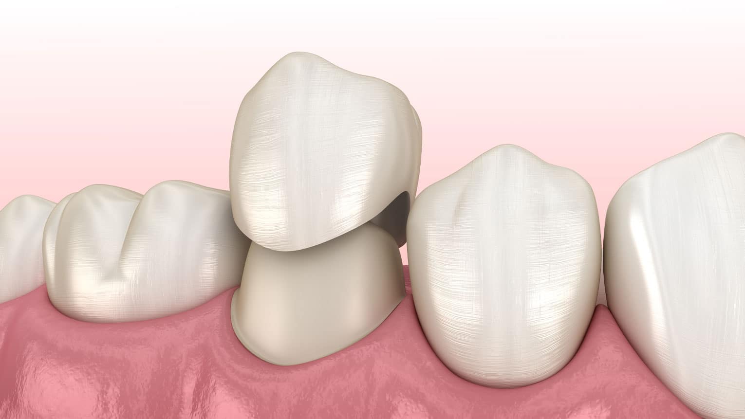 The Role of Temporary Restorations: What They Are and Why You Need Them