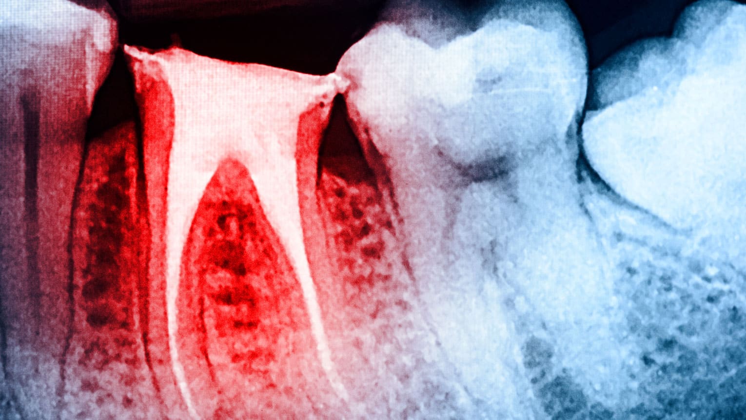 Top 6 Signs You Might Need a Root Canal