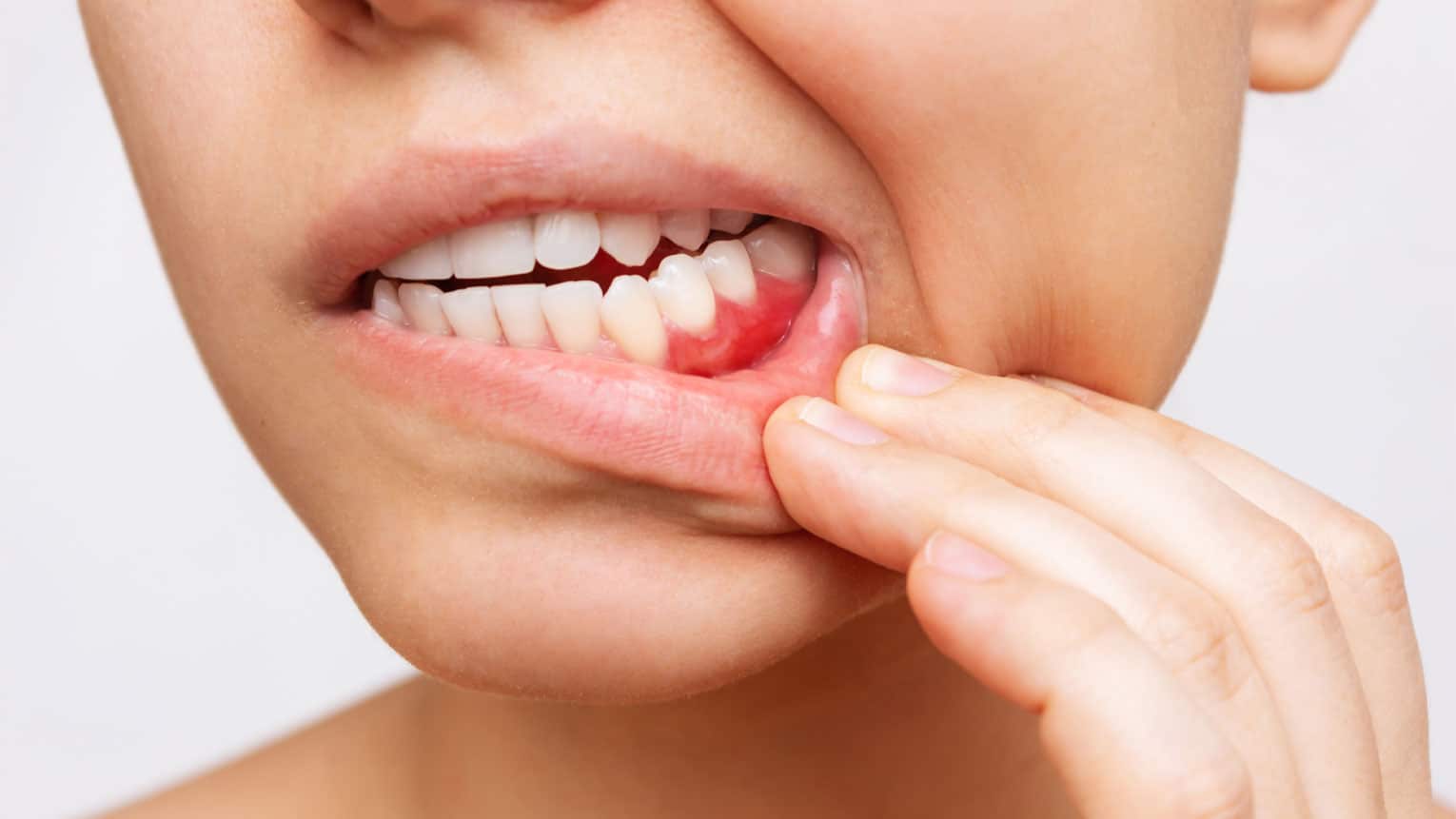 Understanding the Stages of Gum Disease