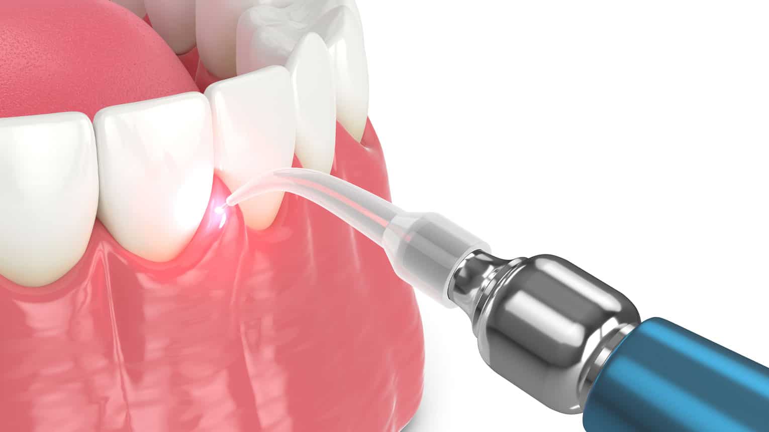 What is Laser Dentistry, and How is it Used?