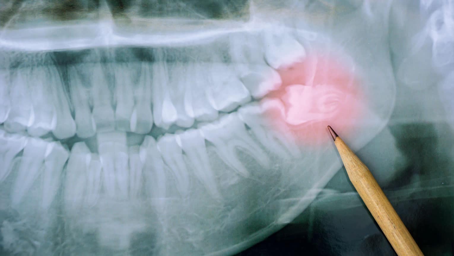 Wisdom Teeth: Why Do We Have Them and When Should They Go?